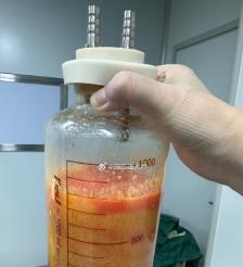 宝应县水动力吸脂手术要做多久？